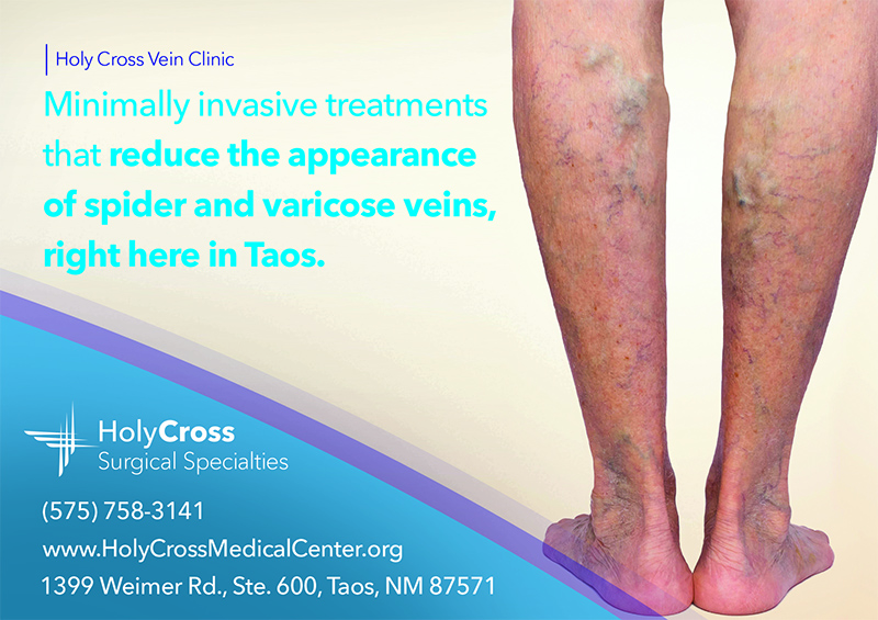 Minimally invasiv treatments that reduce the appearance of spider and varicose veins right here in Taos.